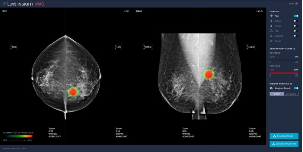 유방암영상검출·진단보조소프트웨어 (자료=식약처 제공)