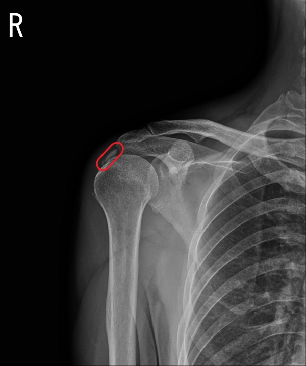 석회성건염 환자 X-ray 사진 (사진=한림대동탄성심병원 제공)